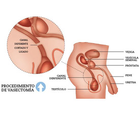 Vasectomía